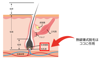 ヒゲ脱毛の施術イメージ